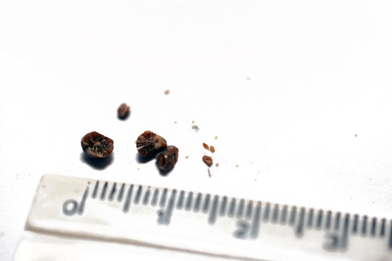 肾结石可以喝普洱熟茶吗：预防肾结石的最佳选择